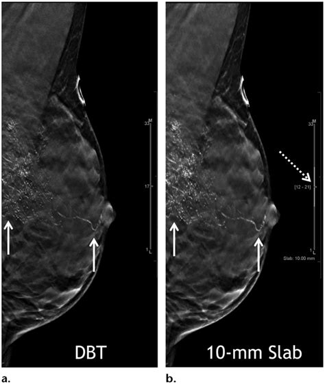 Digital Breast Tomosynthesis: Update on Technology, Evidence, .